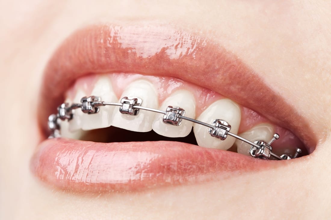 Self Ligating Braces